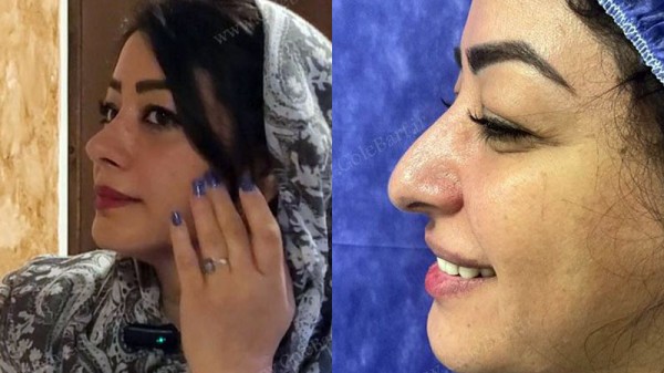 عمل زیبایی بینی