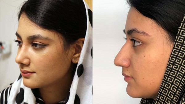 عمل زیبایی بینی